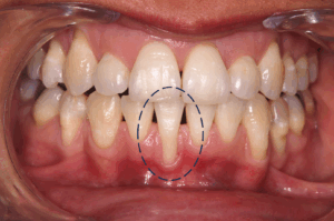 1 - Paciente no satisfecho con retracción importante en la encía de uno de sus dientes inferiores